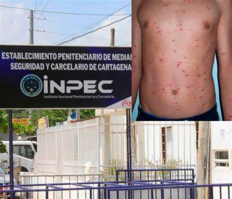 Denuncian ingreso de reclusos a pabellón infestado con brote de varicela